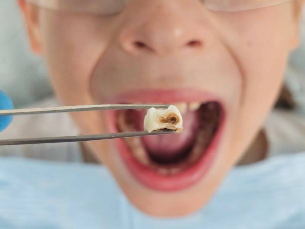Best Emergency Tooth Extraction in Mississippi State, MS