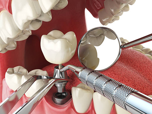 Best Emergency Tooth Extraction in Mississippi State, MS